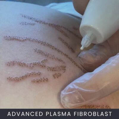 Advanced Plasma Fibroblast Course Online
