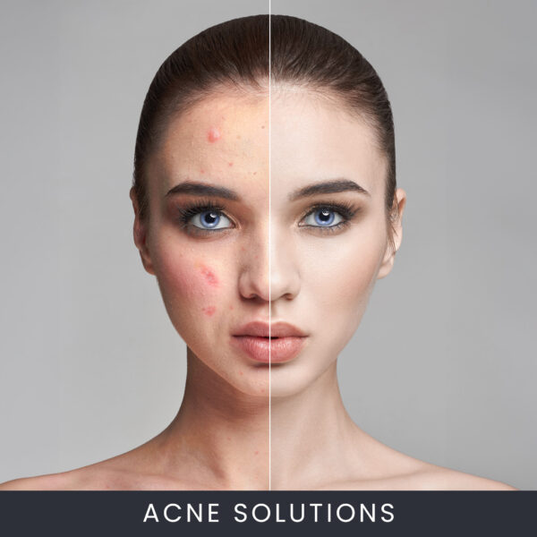 Acne Solutions Facial Course Online Acne Solutions Facial Course Online