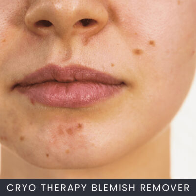 Cryo-Therapy-Blemish-Remover Cryo Therapy Blemish Removal Course Online