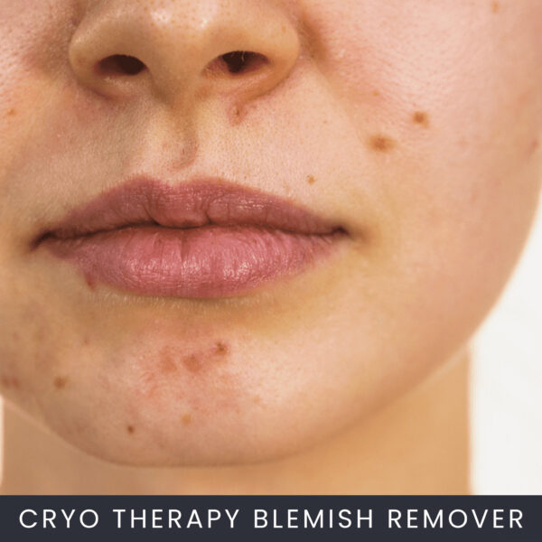 Cryo-Therapy-Blemish-Remover Cryo Therapy Blemish Removal Course Online