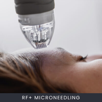 RF+ Microneedling