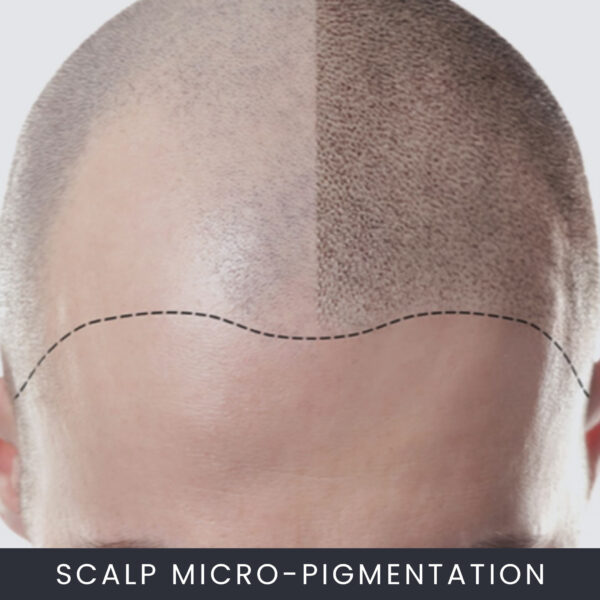 Scalp Micropigmentation Course Online