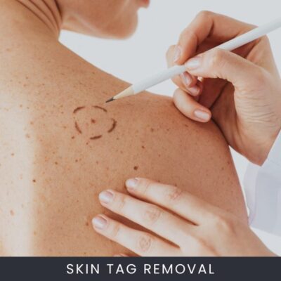 Skin-Tag-Removal--600x600 Skin Tag Removal Course Online