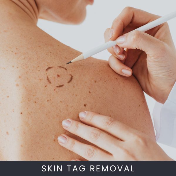 Skin-Tag-Removal--600x600 Skin Tag Removal Course Online