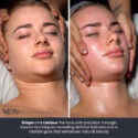 before and after of Korean Contour Facial Massage